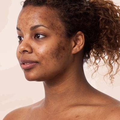Post-acne dark spots and hyperpigmentation on the face